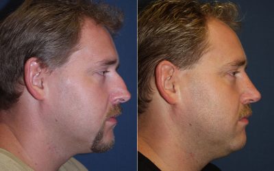 A rhinoplasty for nasal hump reduction: top nose job surgeon in Charlotte NC