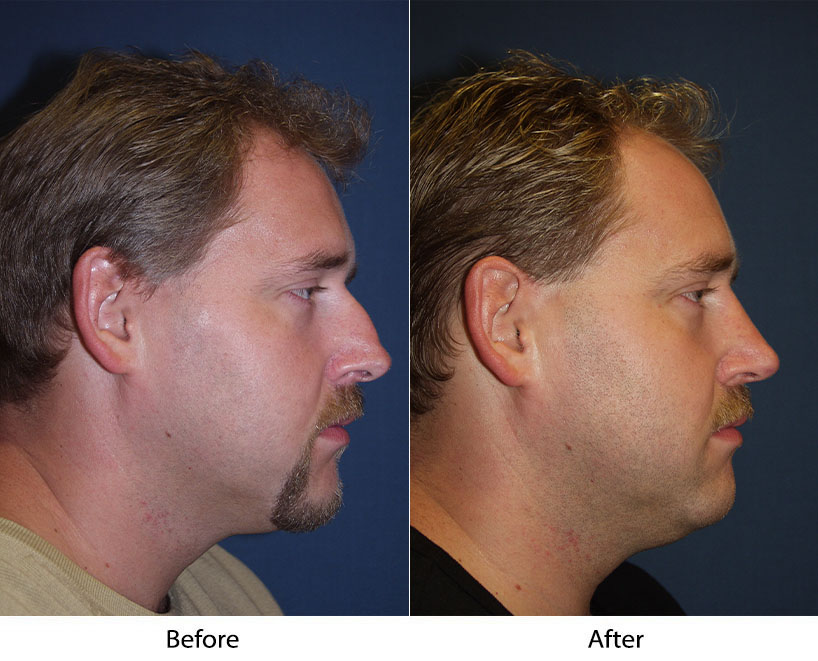 Rhinoplasty to look more male or female