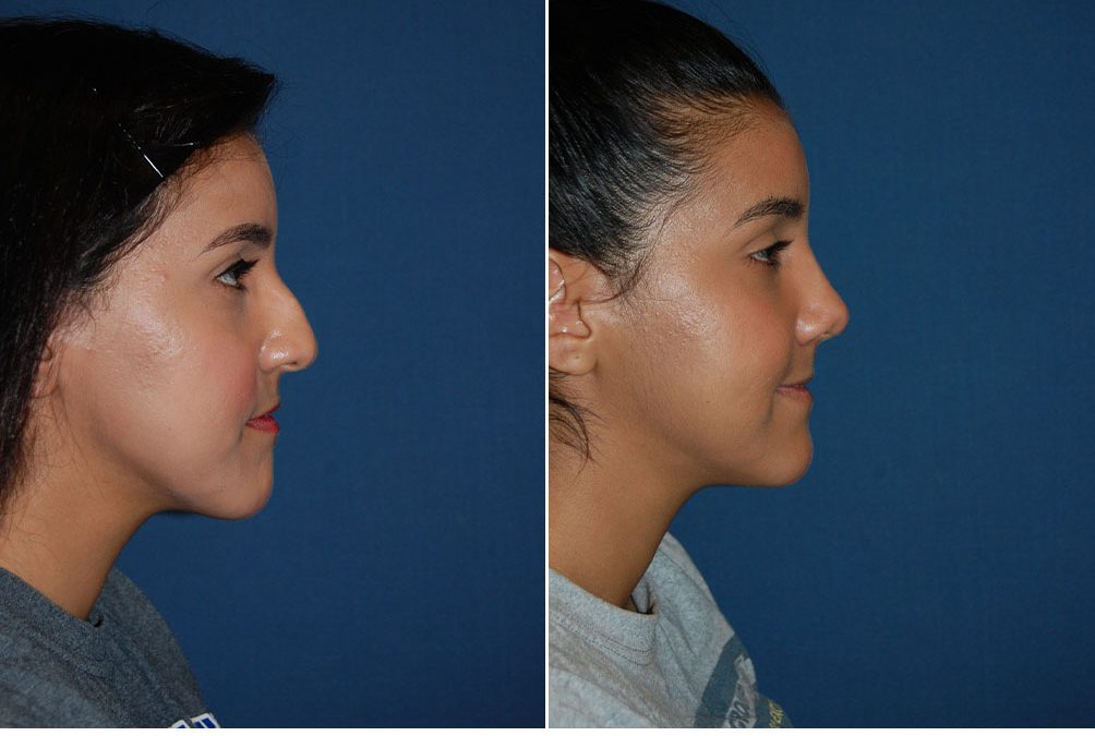 Top rhinoplasty surgeon in Charlotte NC guide to healing after rhinoplasty surgery