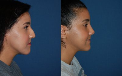 Rhinoplasty and teens