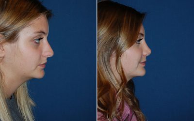 Frequently asked questions about rhinoplasty