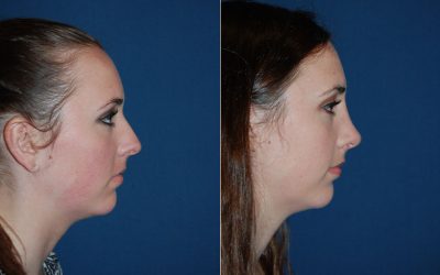 Nose job surgeon in Charlotte explains factors to consider when wanting a rhinoplasty