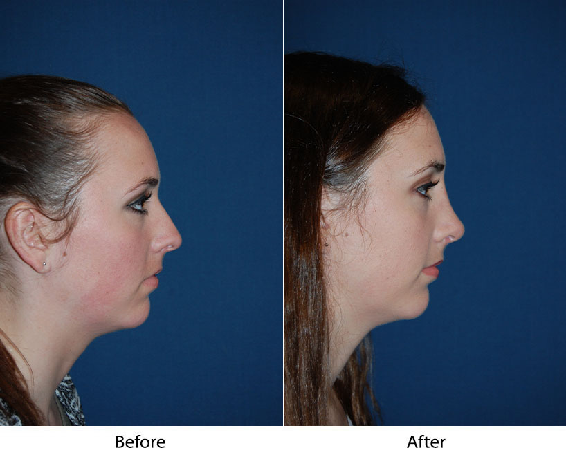 Nose job in Charlotte NC: top facial surgeon debunks popular myths