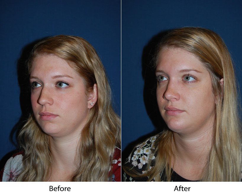 Nose job surgery in Charlotte from the best rhinoplasty surgeon