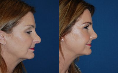 Revision rhinoplasty means you need to see the most experienced surgeon to fix your nose