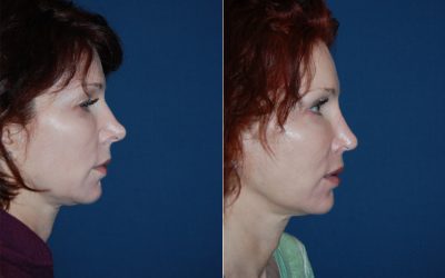 Rhinoplasty the most popular kind of facial plastic surgery