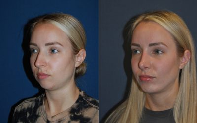 How to find a Charlotte NC rhinoplasty expert?
