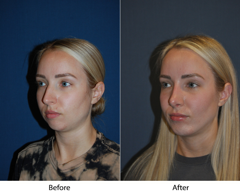 The nose job and what comes after