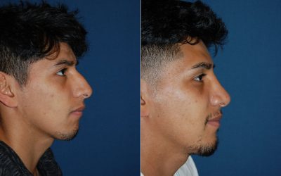 Things people want to know about rhinoplasty