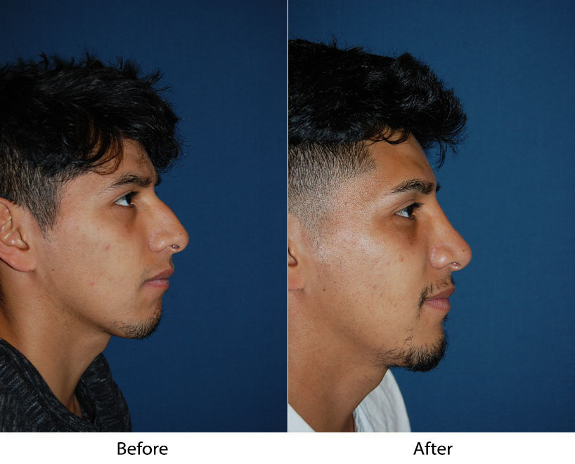 Rhinoplasty and alar rim surgery in Charlotte NC from top facial plastic surgeon