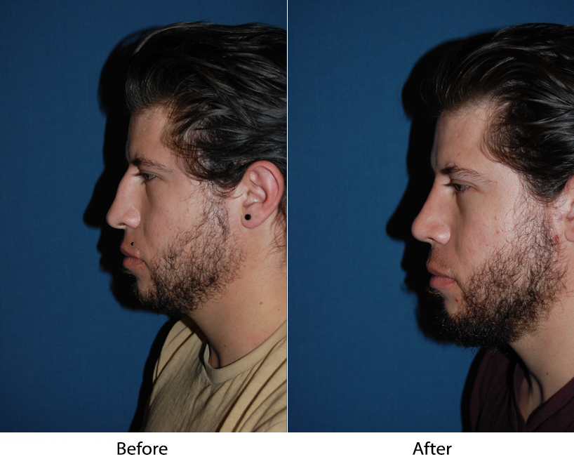 Rhinoplasty recovery- and avoiding the flu during your recovery