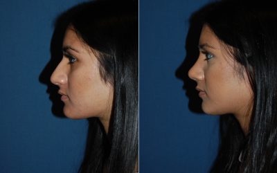 Will Charlotte, NC rhinoplasty expert know when I’m ready?
