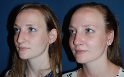 Revision rhinoplasty offers hope