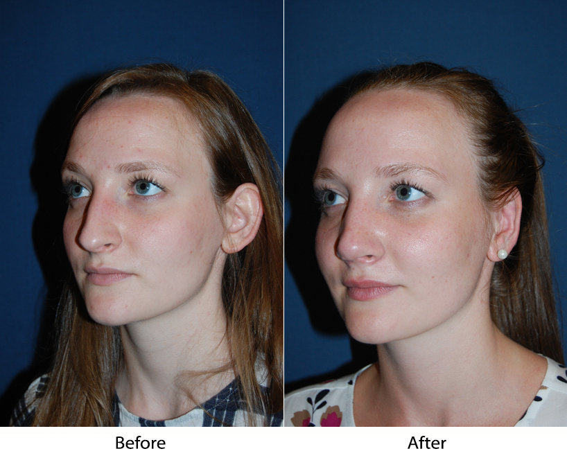 Rhinoplasty and how to recover