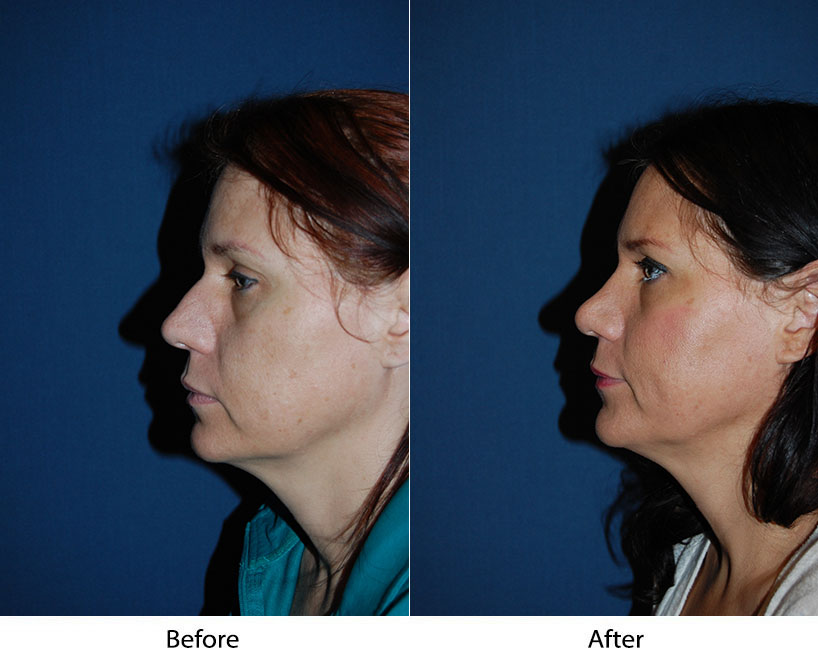 What should I know about Charlotte NC rhinoplasty?