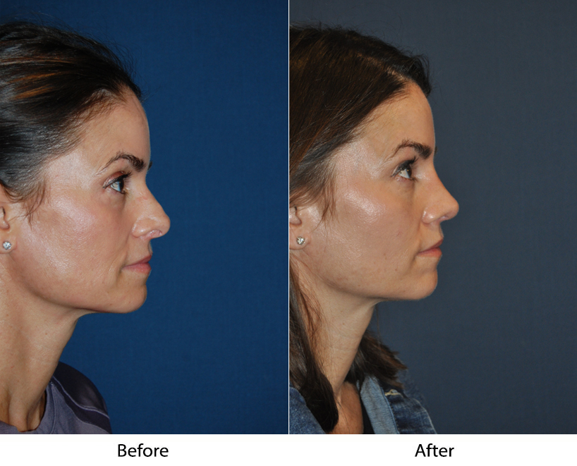 Find out more about teen rhinoplasty in Charlotte NC procedures?