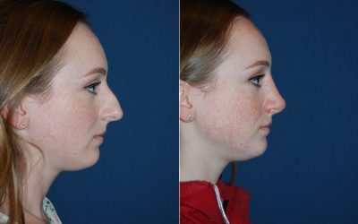 Going through the process of rhinoplasty