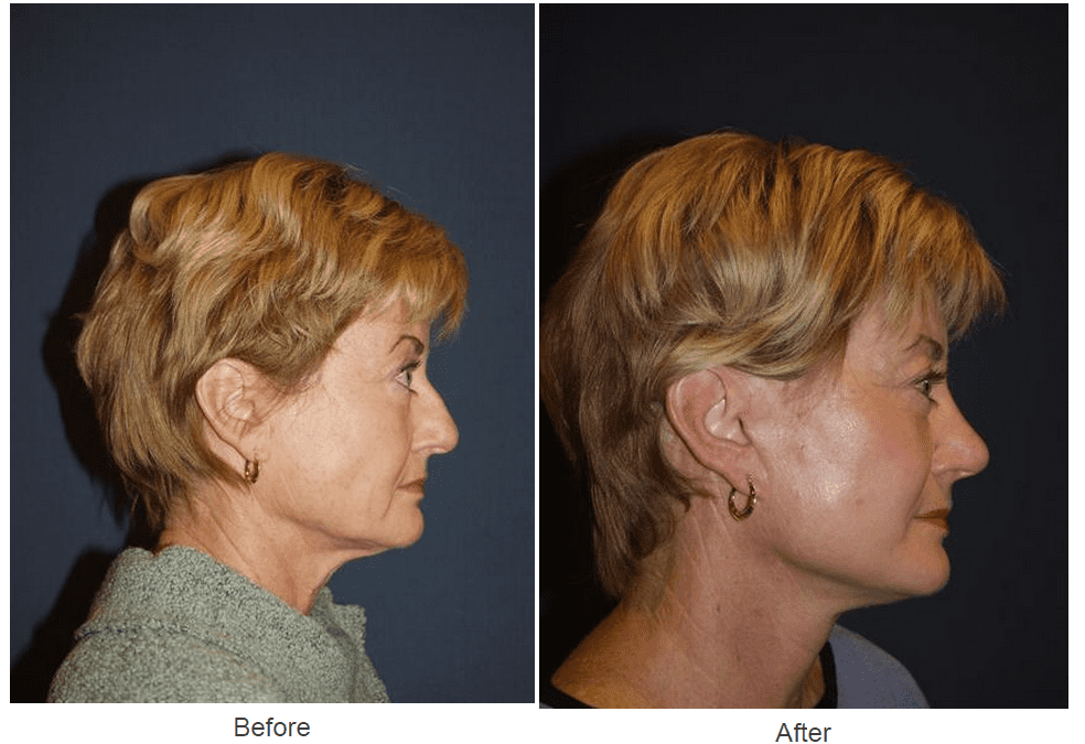 Charlotte’s best rhinoplasty expert answers nose job revision procedure questions
