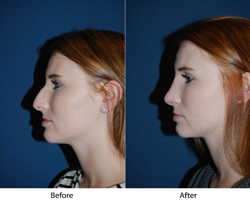 Rhinoplasty specialist in Charlotte NC explains the different rhinoplasty procedure types
