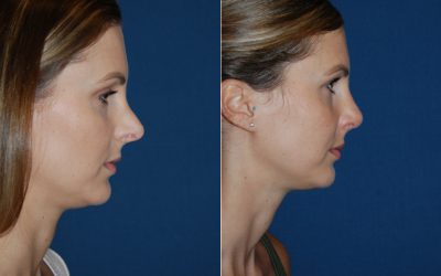 Rhinoplasty specialist in Charlotte NC: learn from the top nose job surgeon