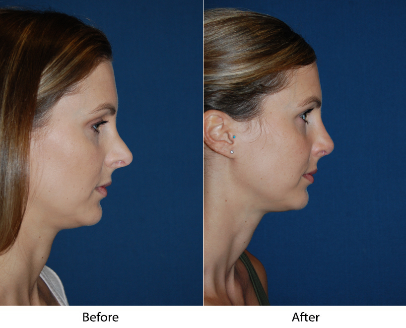 Rhinoplasty specialist in Charlotte do more than one surgery