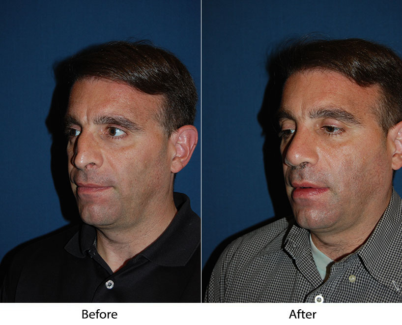 When it comes to rhinoplasty, hire the best