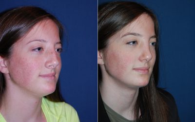 Teen rhinoplasty- get my teen a nose job