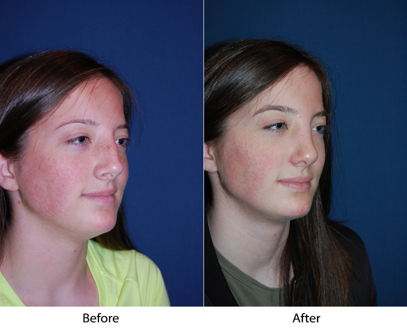 Teen rhinoplasty widely sought in Charlotte, NC