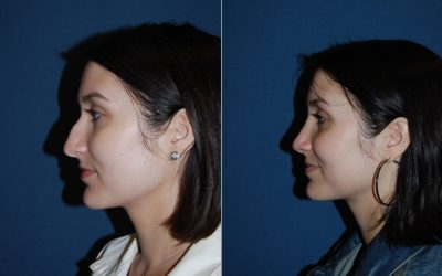 The nose job has a long history, and the art has greatly advanced.