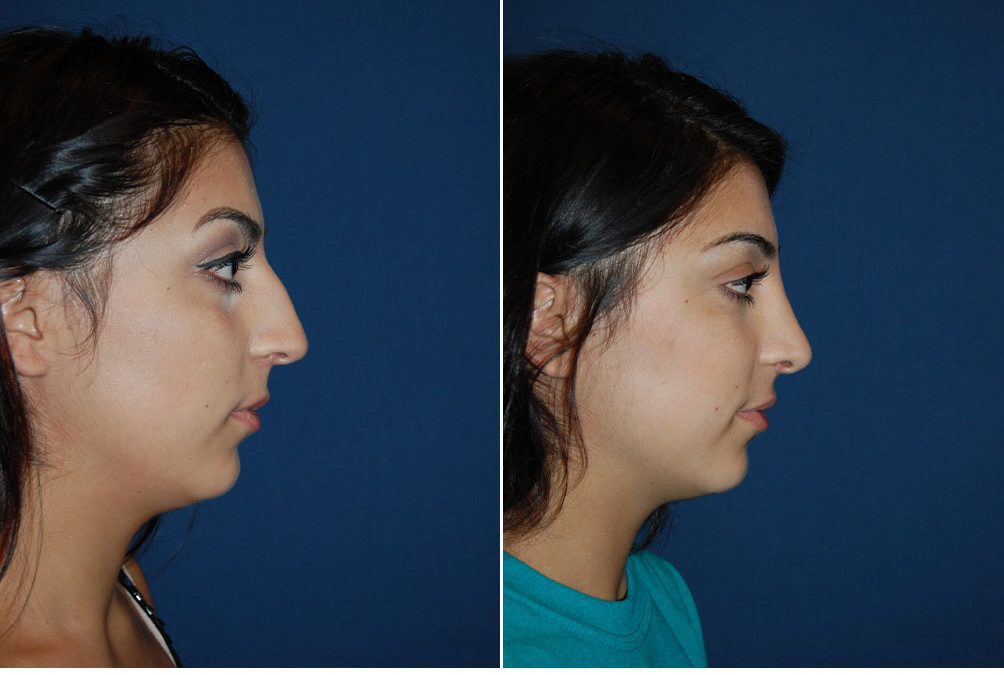 Charlotte nose job surgeon- finding the very best one