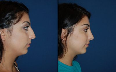 Nose job surgeon in Charlotte NC explains what to do with botched rhinoplasty