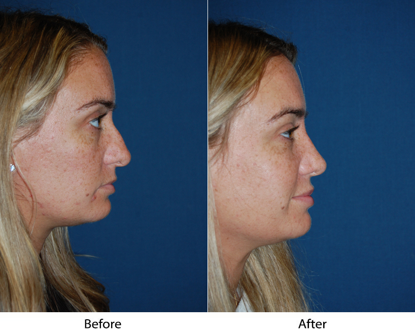 Best nose job surgeon in Charlotte, NC and why