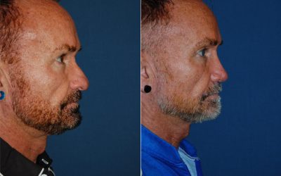 Best nose surgery for patients in Charlotte wanting to change the size of their nose