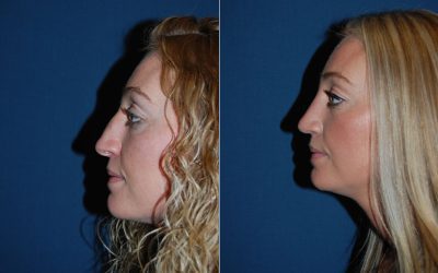 Nose job in Charlotte; quick facts and explanation of a rhinoplasty