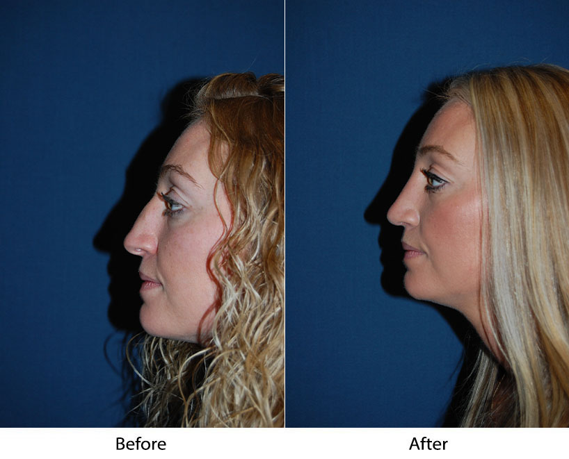 Nose job in Charlotte; quick facts and explanation of a rhinoplasty