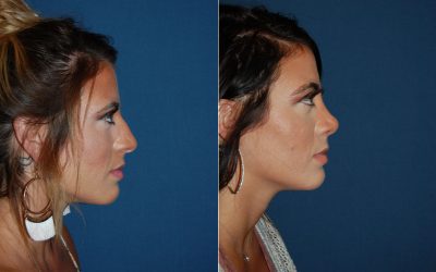 Nose job procedure, recovery, and more in Charlotte, NC