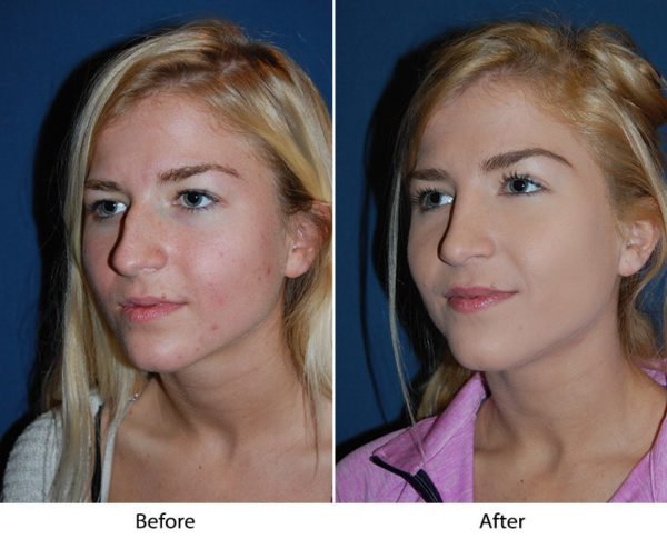 Charlotte’s best rhinoplasty specialist explains traveling after a nose job