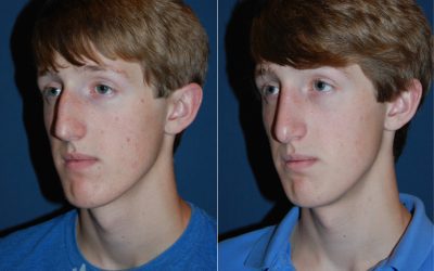 Teen rhinoplasty surgeons in Charlotte NC can improve a teen’s nose shape