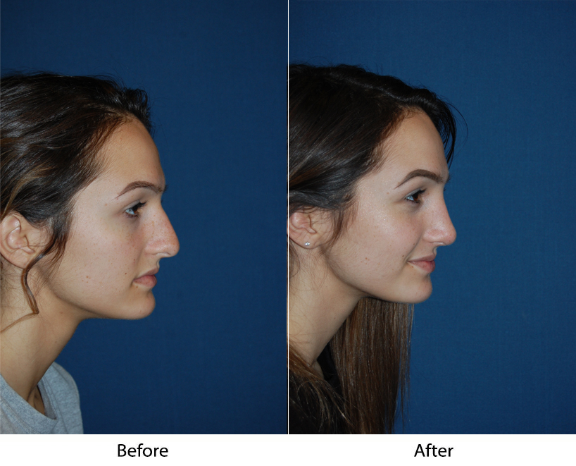 Is teen rhinoplasty in Charlotte, NC, safe? Ask the top facial plastic surgeon