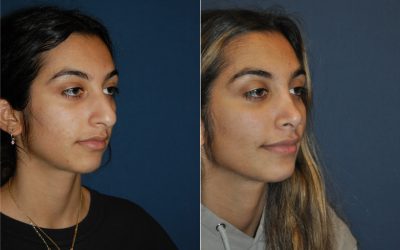 Nose job surgeon in Charlotte NC offers dorsal hump removal