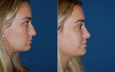 Why is nose surgery do popular in Charlotte NC: Find top facial plastic surgeon