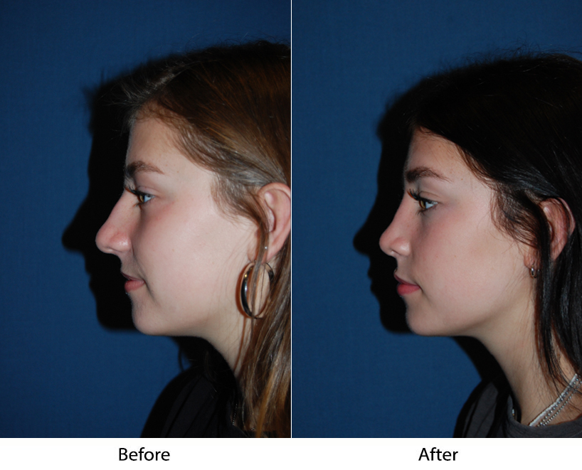 Consider these facts before deciding on teen rhinoplasty surgery