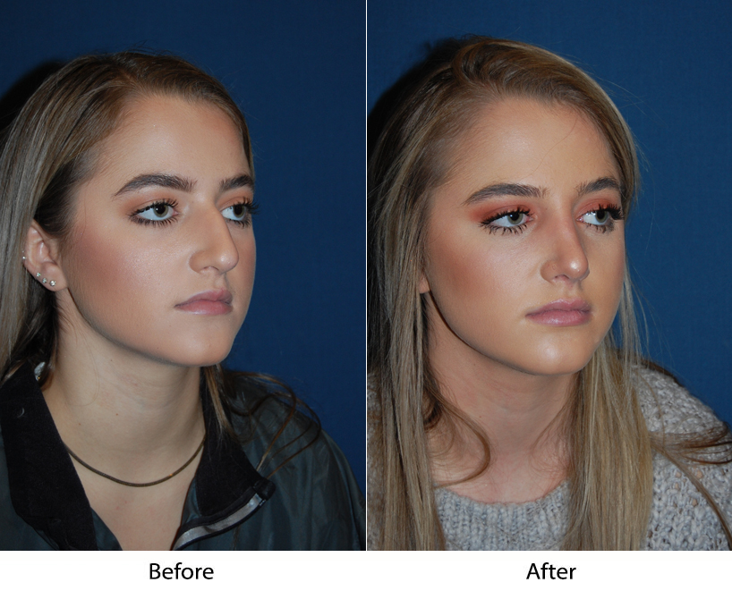Top teen rhinoplasty surgeon in Charlotte discusses a teen nose job