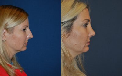 Best Charlotte rhinoplasty surgeon explain how nose job creates facial harmony