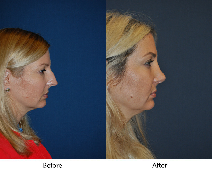 Best Charlotte rhinoplasty surgeon explain how nose job creates facial harmony
