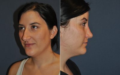 Charlotte’s best rhinoplasty specialist explains the different types of procedures