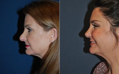 Charlotte’s best facial plastic surgeon demystifies rhinoplasty myths and misconceptions