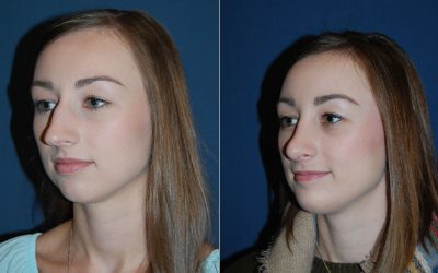 Charlotte’s teen rhinoplasty surgeons explain nose job for teens