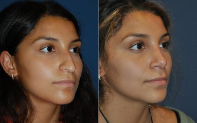 Best Charlotte Rhinoplasty surgeons explain what to look for in a specialist
