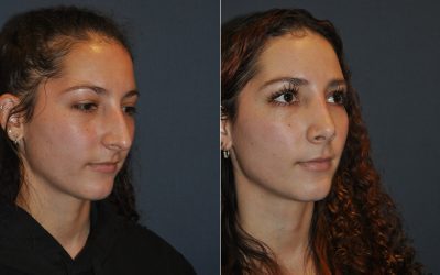 Charlotte’s rhinoplasty specialists explain nose job failure